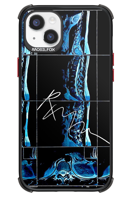 RMN Scolioza 2.0 - Apple iPhone 14 Plus