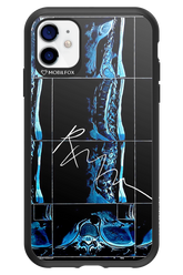 RMN Scolioza 2.0 - Apple iPhone 11