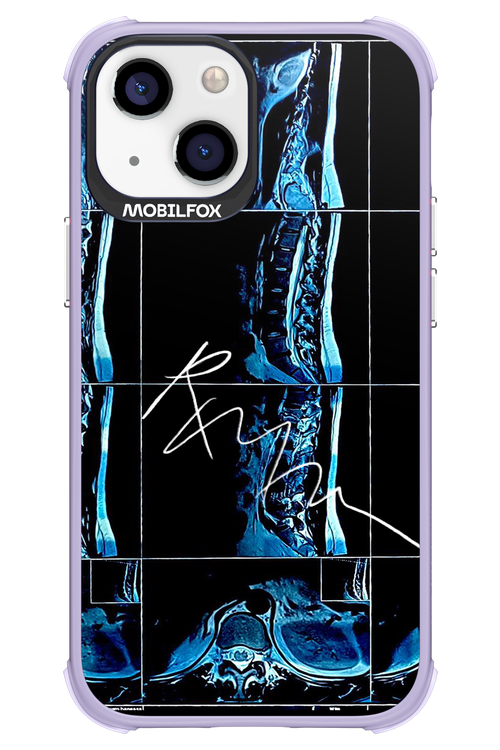 RMN Scolioza 2.0 - Apple iPhone 13 Mini