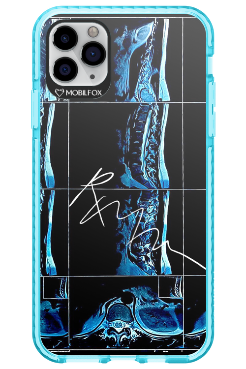 RMN Scolioza 2.0 - Apple iPhone 11 Pro Max