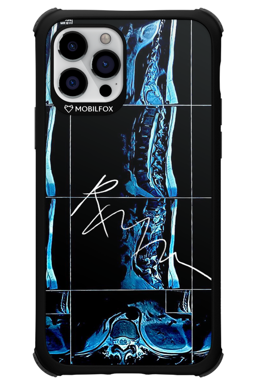 RMN Scolioza 2.0 - Apple iPhone 12 Pro