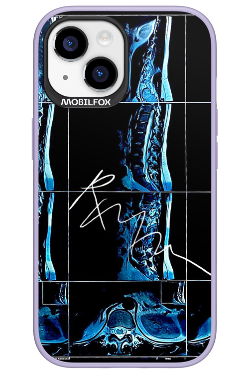 RMN Scolioza 2.0 - Apple iPhone 15