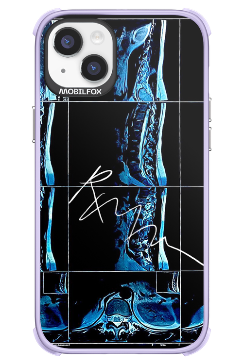 RMN Scolioza 2.0 - Apple iPhone 14 Plus