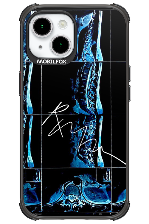 RMN Scolioza 2.0 - Apple iPhone 15