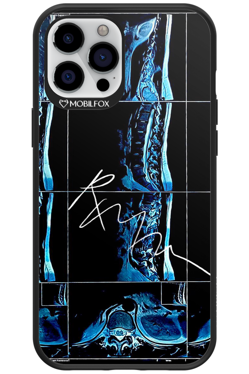 RMN Scolioza 2.0 - Apple iPhone 12 Pro Max