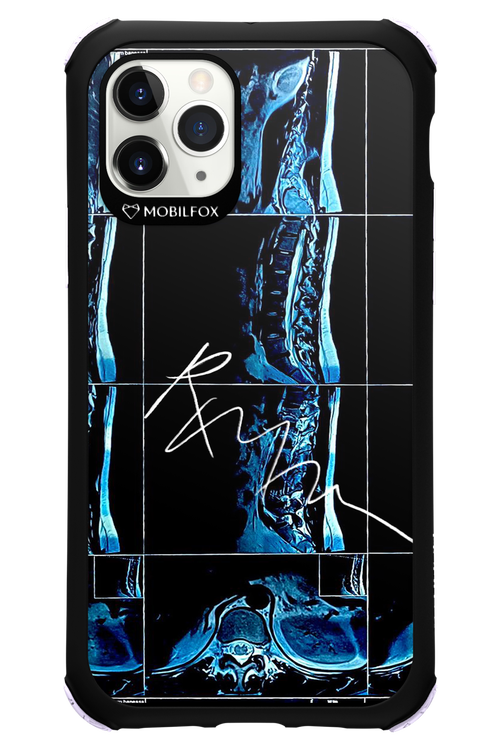RMN Scolioza 2.0 - Apple iPhone 11 Pro