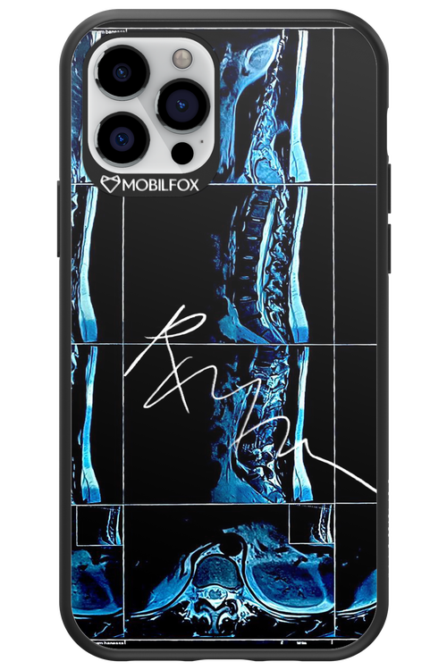RMN Scolioza 2.0 - Apple iPhone 12 Pro