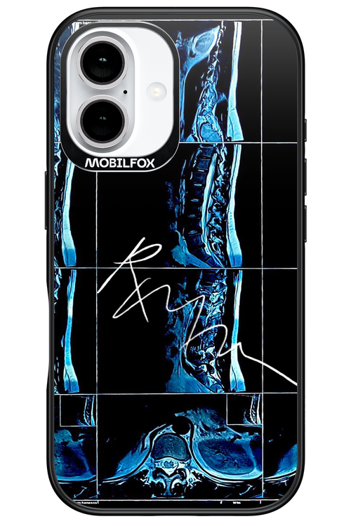 RMN Scolioza 2.0 - Apple iPhone 16