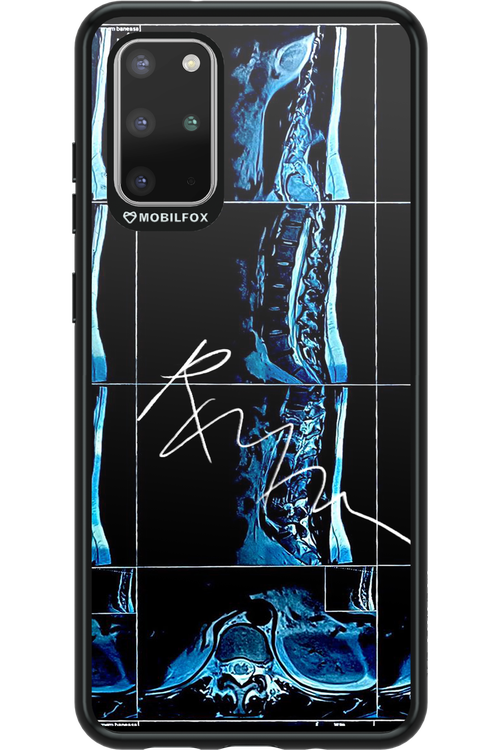 RMN Scolioza 2.0 - Samsung Galaxy S20+