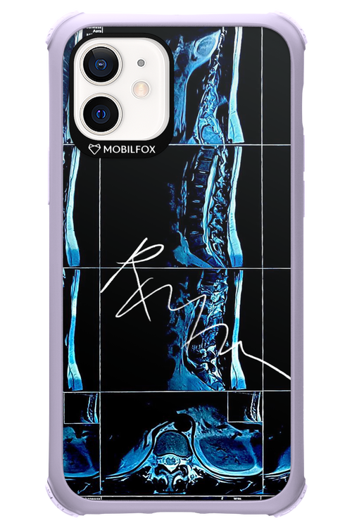 RMN Scolioza 2.0 - Apple iPhone 12