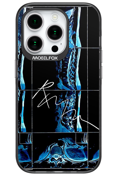 RMN Scolioza 2.0 - Apple iPhone 15 Pro