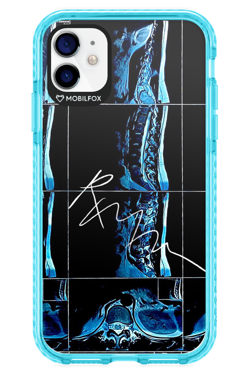 RMN Scolioza 2.0 - Apple iPhone 11