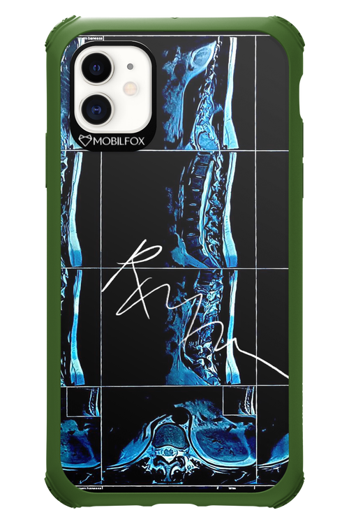 RMN Scolioza 2.0 - Apple iPhone 11