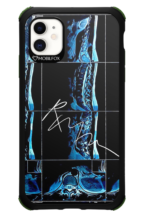 RMN Scolioza 2.0 - Apple iPhone 11