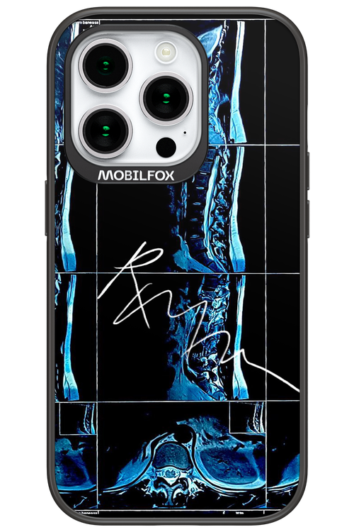 RMN Scolioza 2.0 - Apple iPhone 15 Pro
