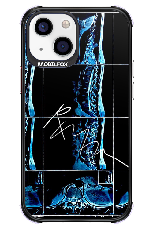 RMN Scolioza 2.0 - Apple iPhone 13 Mini