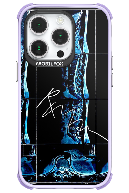 RMN Scolioza 2.0 - Apple iPhone 14 Pro