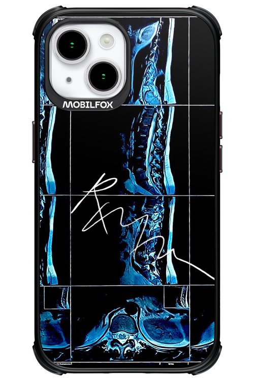 RMN Scolioza 2.0 - Apple iPhone 15
