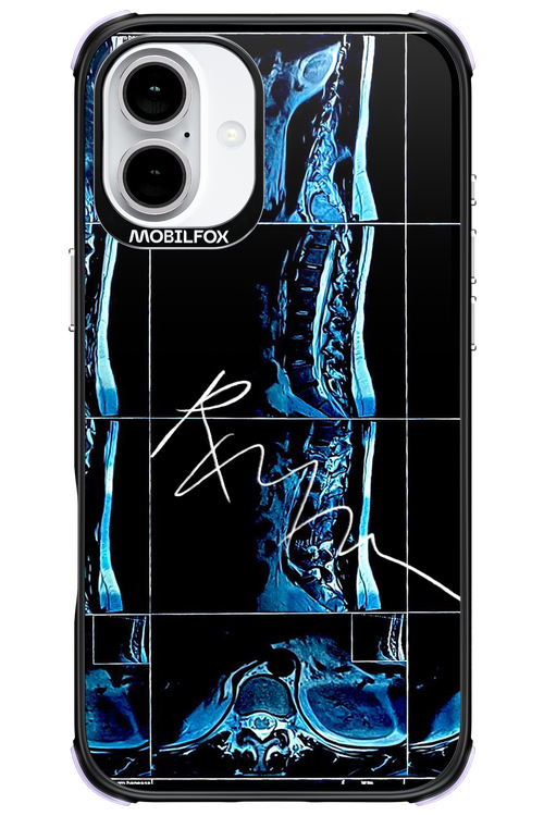 RMN Scolioza 2.0 - Apple iPhone 16 Plus