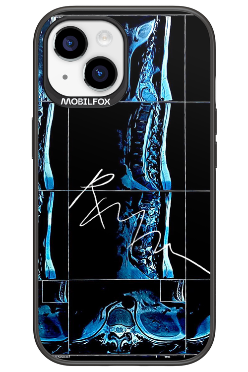 RMN Scolioza 2.0 - Apple iPhone 15