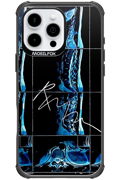 RMN Scolioza 2.0 - Apple iPhone 16 Pro Max