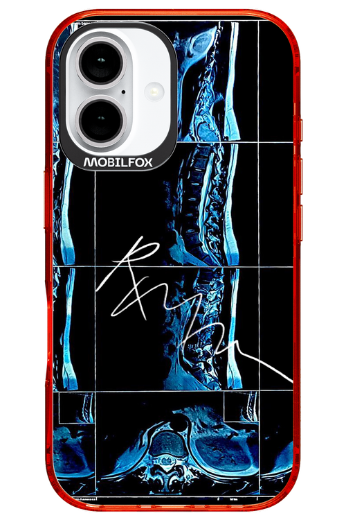 RMN Scolioza 2.0 - Apple iPhone 16