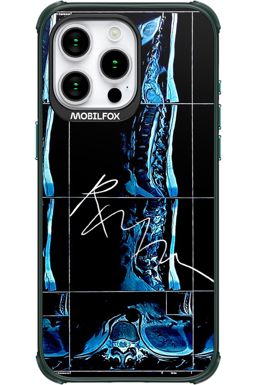RMN Scolioza - Apple iPhone 15 Pro Max