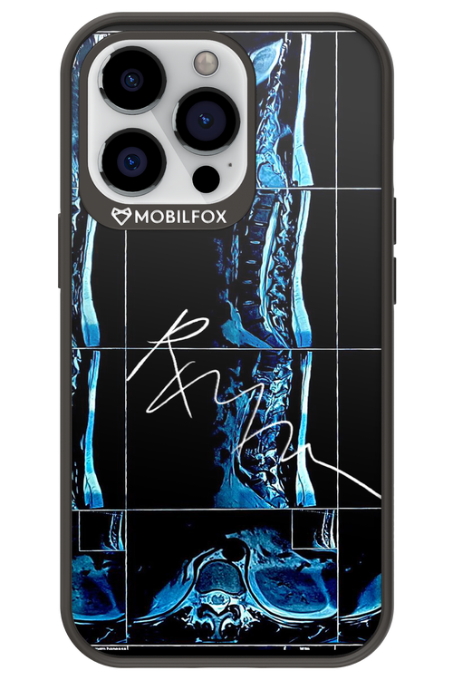 RMN Scolioza 2.0 - Apple iPhone 13 Pro