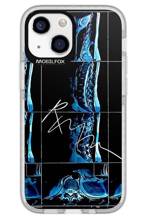 RMN Scolioza 2.0 - Apple iPhone 13 Mini