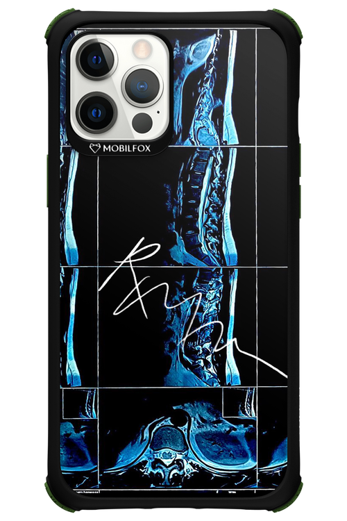RMN Scolioza 2.0 - Apple iPhone 12 Pro Max