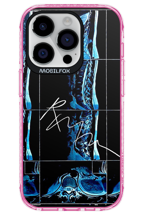 RMN Scolioza 2.0 - Apple iPhone 14 Pro