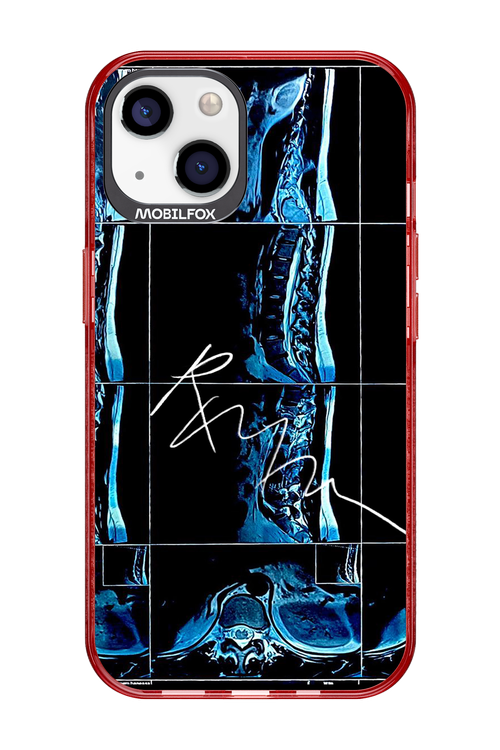 RMN Scolioza 2.0 - Apple iPhone 13