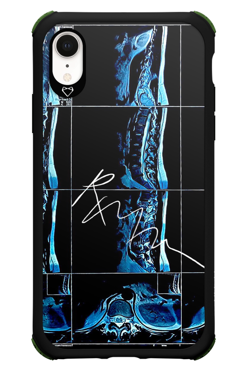 RMN Scolioza 2.0 - Apple iPhone XR