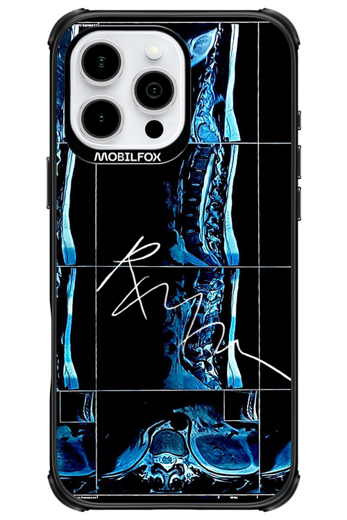 RMN Scolioza 2.0 - Apple iPhone 16 Pro Max