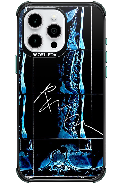 RMN Scolioza 2.0 - Apple iPhone 16 Pro Max
