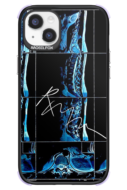 RMN Scolioza 2.0 - Apple iPhone 14 Plus