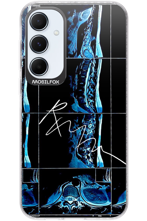 RMN Scolioza 2.0 - Samsung Galaxy A55