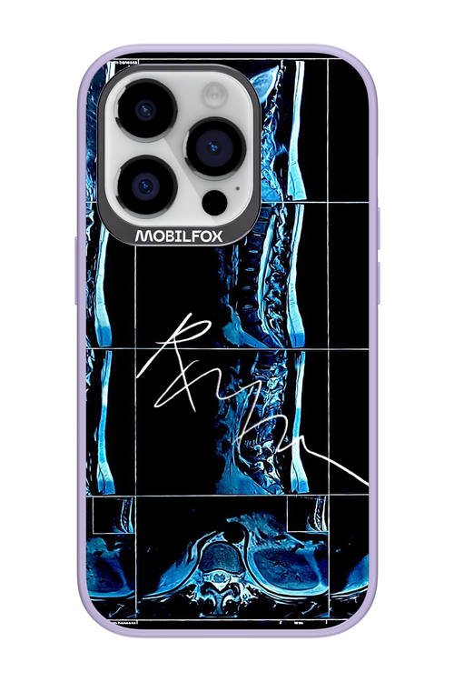 RMN Scolioza 2.0 - Apple iPhone 14 Pro