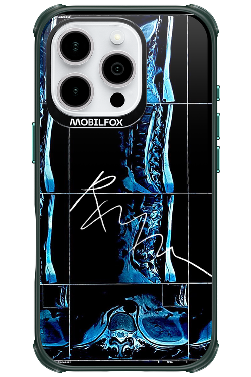 RMN Scolioza 2.0 - Apple iPhone 16 Pro
