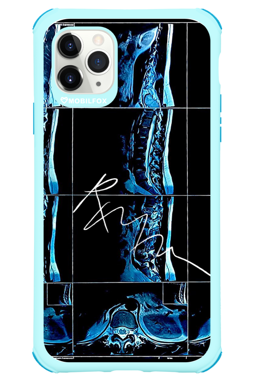 RMN Scolioza 2.0 - Apple iPhone 11 Pro Max