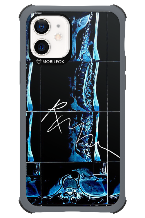 RMN Scolioza 2.0 - Apple iPhone 12