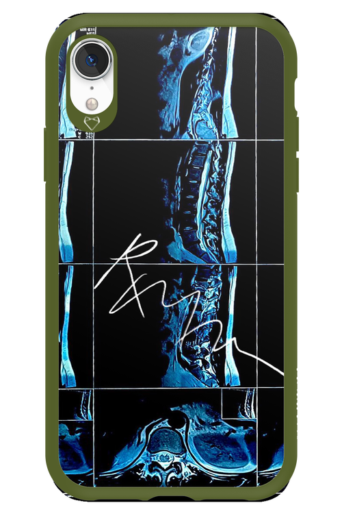 RMN Scolioza 2.0 - Apple iPhone XR