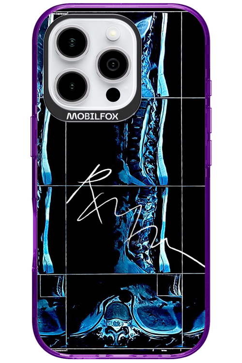 RMN Scolioza 2.0 - Apple iPhone 16 Pro