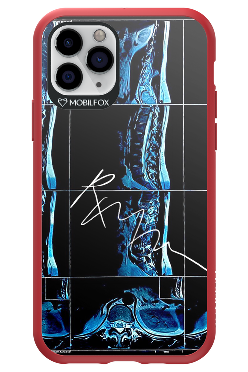 RMN Scolioza 2.0 - Apple iPhone 11 Pro