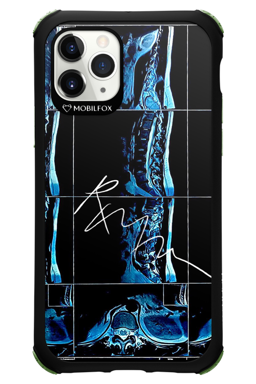 RMN Scolioza 2.0 - Apple iPhone 11 Pro