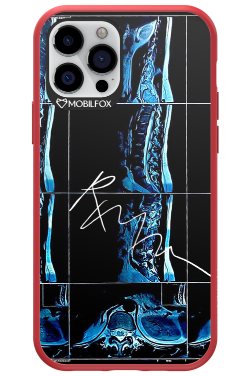 RMN Scolioza 2.0 - Apple iPhone 12 Pro