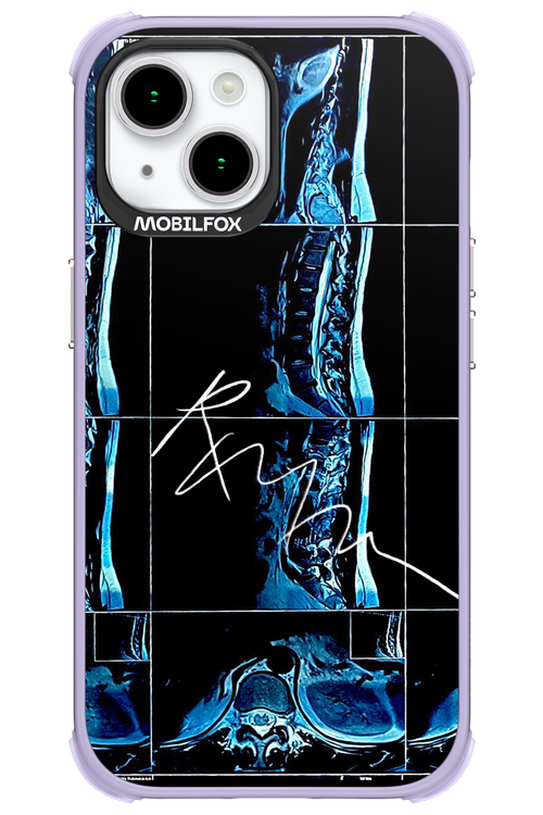 RMN Scolioza 2.0 - Apple iPhone 15