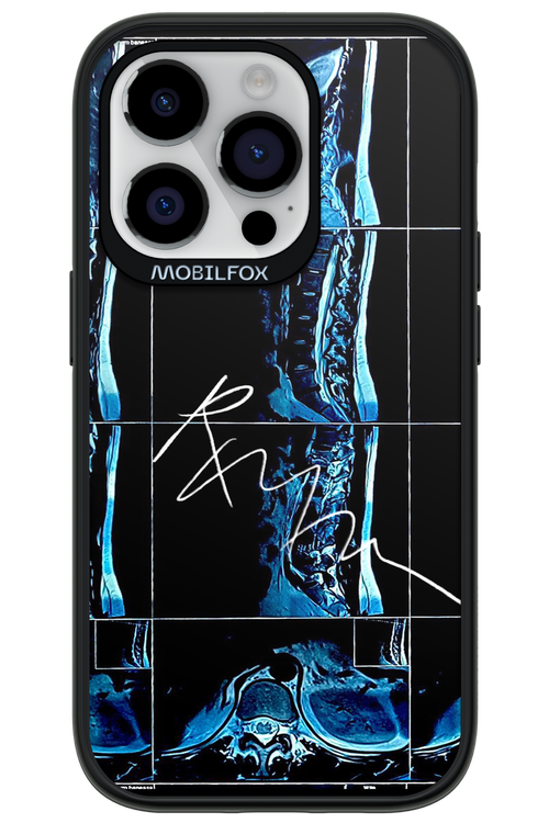 RMN Scolioza 2.0 - Apple iPhone 14 Pro