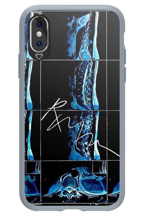 RMN Scolioza 2.0 - Apple iPhone X