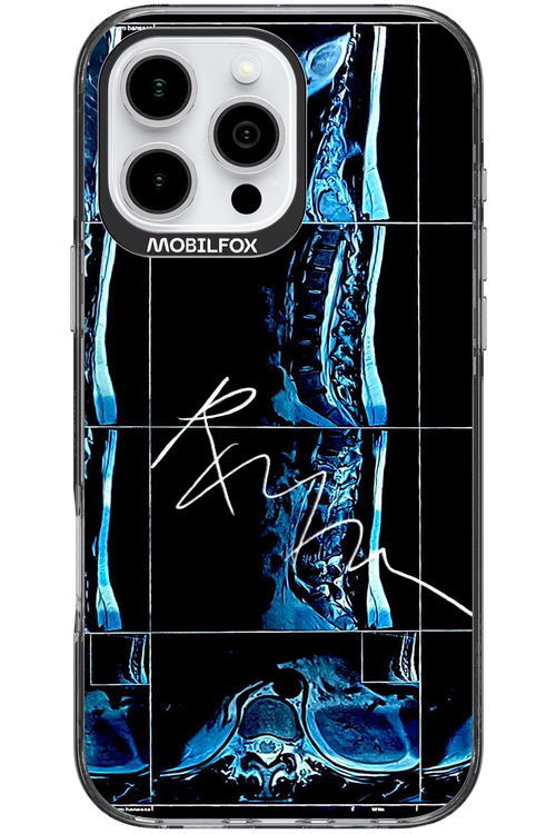 RMN Scolioza 2.0 - Apple iPhone 16 Pro Max